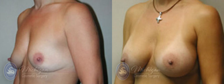 Breast Augmentation Before and After Photo by Dr. Awada in Southfield Michigan