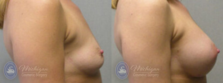 Breast Augmentation Before and After Photo by Dr. Awada in Southfield Michigan