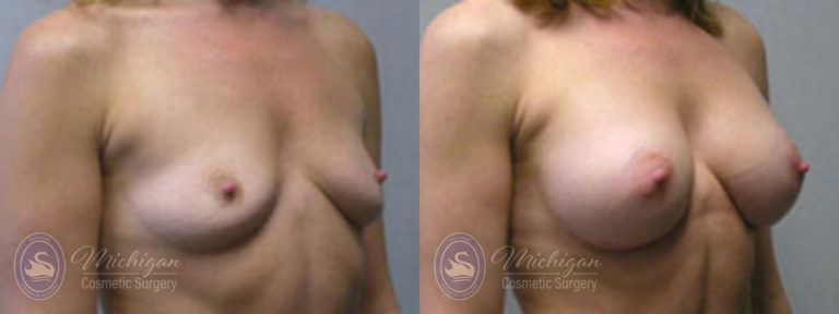 Breast Augmentation Before and After Photo by Dr. Awada in Southfield Michigan