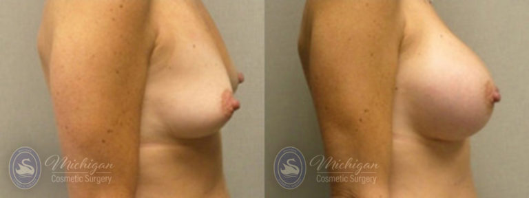 Breast Augmentation Before and After Photo by Dr. Awada in Southfield Michigan