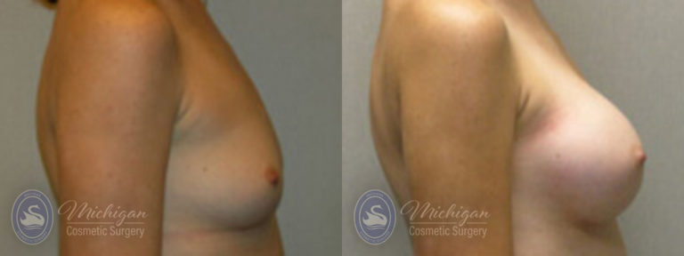 Breast Augmentation Before and After Photo by Dr. Awada in Southfield Michigan
