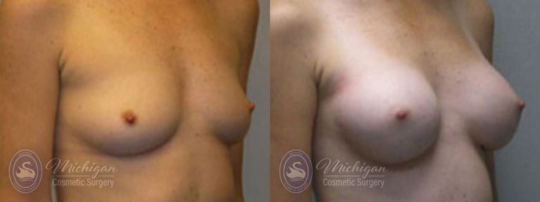 Breast Augmentation Before and After Photo by Dr. Awada in Southfield Michigan