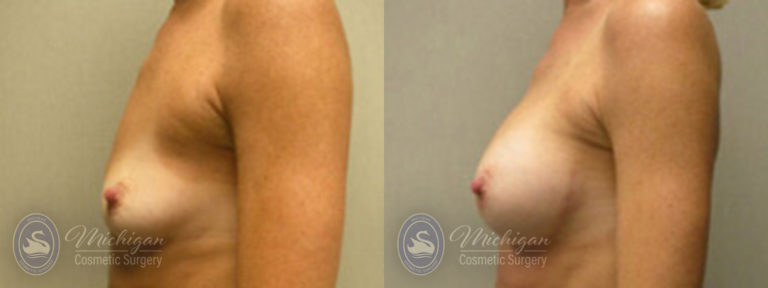 Breast Augmentation Before and After Photo by Dr. Awada in Southfield Michigan