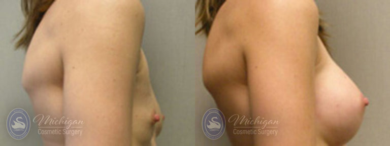 Breast Augmentation Before and After Photo by Dr. Awada in Southfield Michigan