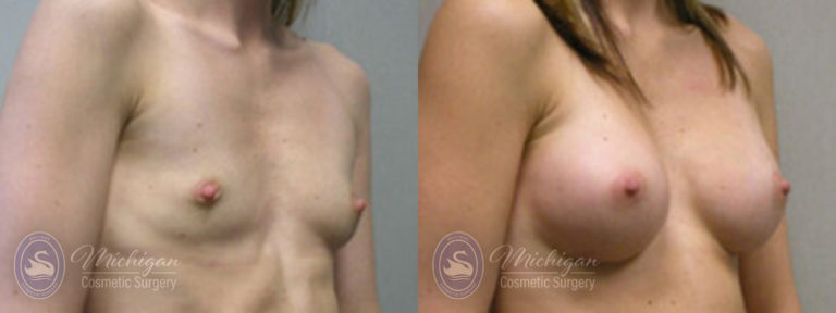 Breast Augmentation Before and After Photo by Dr. Awada in Southfield Michigan