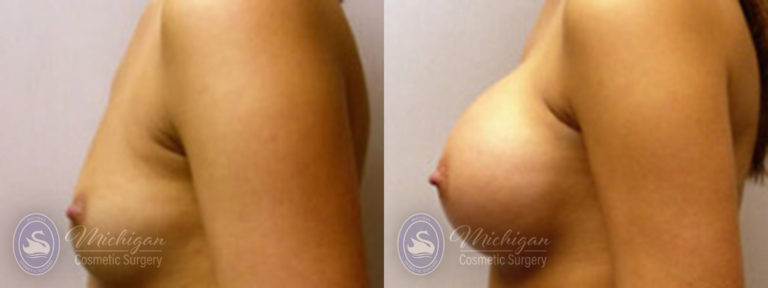 Breast Augmentation Before and After Photo by Dr. Awada in Southfield Michigan