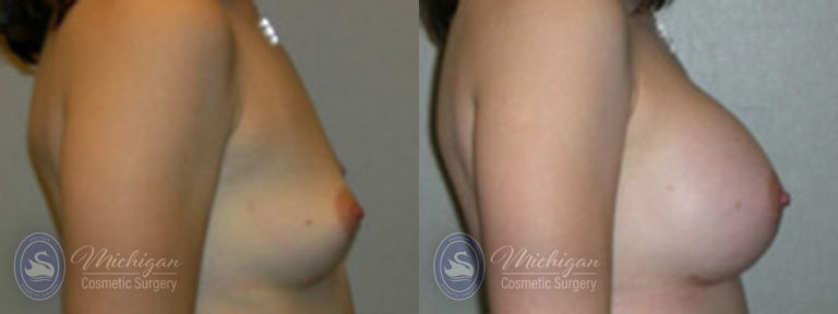 Breast Augmentation Before and After Photo by Dr. Awada in Southfield Michigan