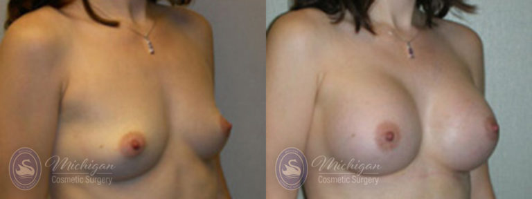 Breast Augmentation Before and After Photo by Dr. Awada in Southfield Michigan