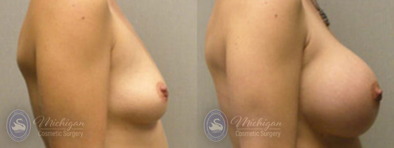 Breast Augmentation Before and After Photo by Dr. Awada in Southfield Michigan