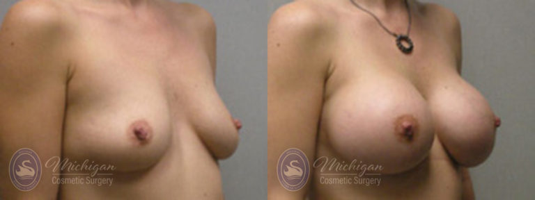 Breast Augmentation Before and After Photo by Dr. Awada in Southfield Michigan