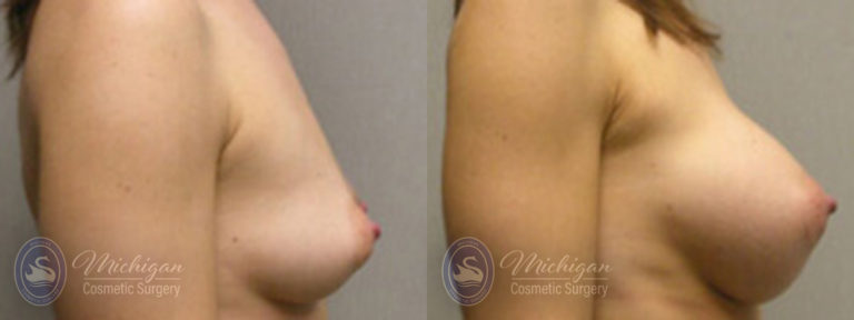 Breast Augmentation Before and After Photo by Dr. Awada in Southfield Michigan