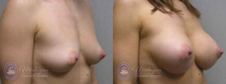 Breast Augmentation Before and After Photo by Dr. Awada in Southfield Michigan