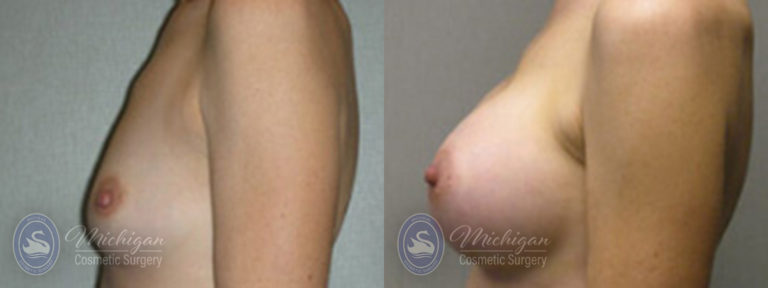 Breast Augmentation Before and After Photo by Dr. Awada in Southfield Michigan