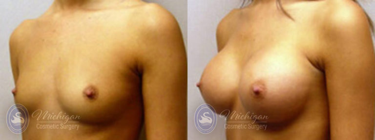 Breast Augmentation Before and After Photo by Dr. Awada in Southfield Michigan