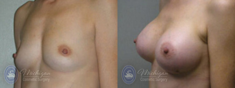 Breast Augmentation Before and After Photo by Dr. Awada in Southfield Michigan