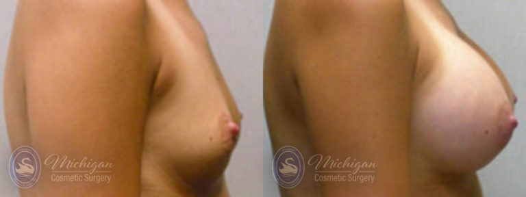 Breast Augmentation Before and After Photo by Dr. Awada in Southfield Michigan