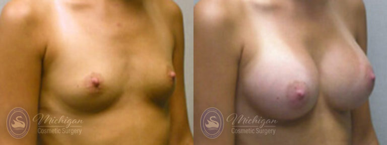 Breast Augmentation Before and After Photo by Dr. Awada in Southfield Michigan
