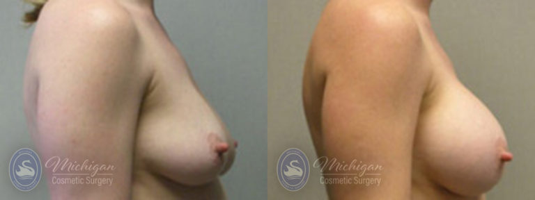 Breast Augmentation Before and After Photo by Dr. Awada in Southfield Michigan