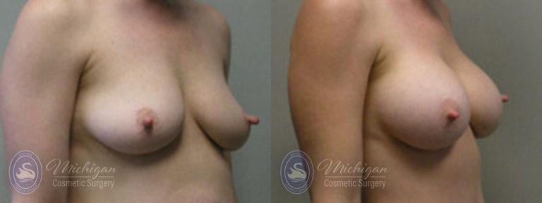 Breast Augmentation Before and After Photo by Dr. Awada in Southfield Michigan