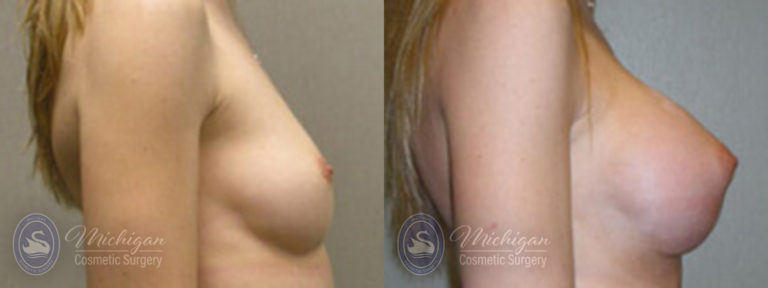 Breast Augmentation Before and After Photo by Dr. Awada in Southfield Michigan