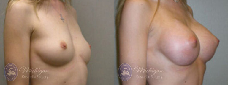 Breast Augmentation Before and After Photo by Dr. Awada in Southfield Michigan