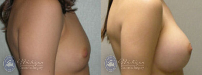Breast Augmentation Before and After Photo by Dr. Awada in Southfield Michigan