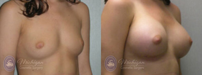 Breast Augmentation Before and After Photo by Dr. Awada in Southfield Michigan