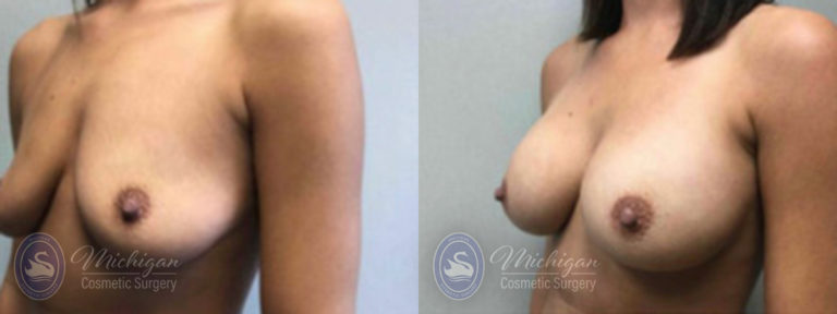 Breast Augmentation Before and After Photo by Dr. Awada in Southfield Michigan