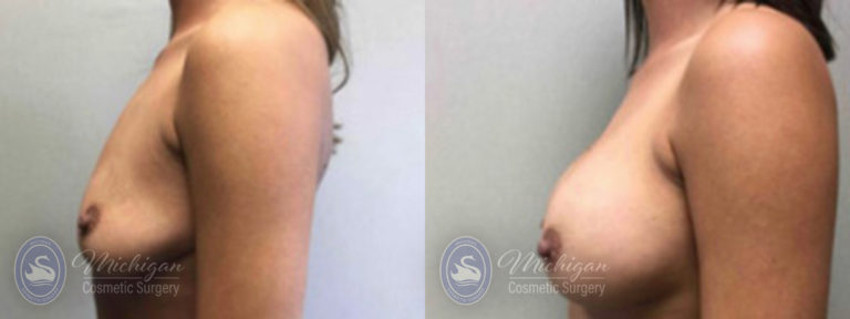 Breast Augmentation Before and After Photo by Dr. Awada in Southfield Michigan