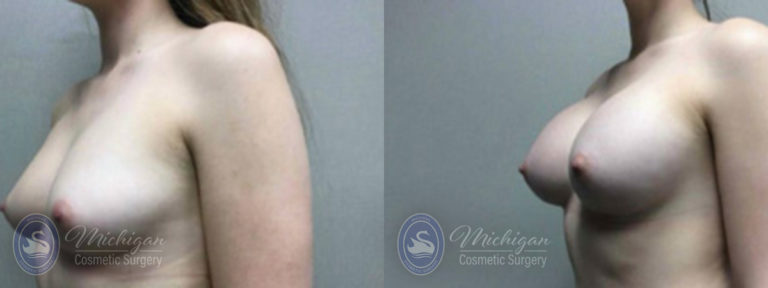 Breast Augmentation Before and After Photo by Dr. Awada in Southfield Michigan