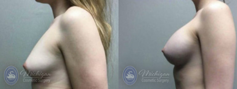 Breast Augmentation Before and After Photo by Dr. Awada in Southfield Michigan