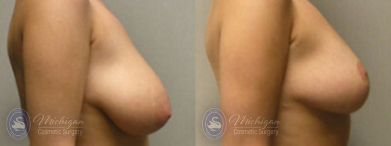 Breast Lift Before and After Photo by Dr. Awada in Southfield Michigan