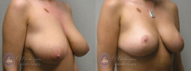 Breast Lift Before and After Photo by Dr. Awada in Southfield Michigan