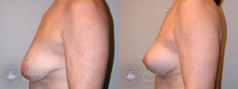 Breast Lift Before and After Photo by Dr. Awada in Southfield Michigan