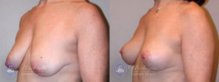 Breast Lift Before and After Photo by Dr. Awada in Southfield Michigan
