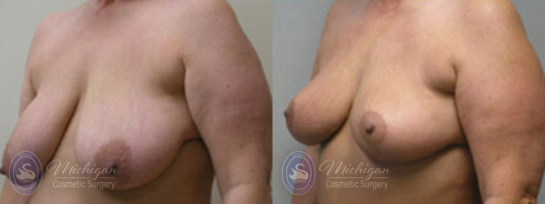 Breast Lift Before and After Photo by Dr. Awada in Southfield Michigan