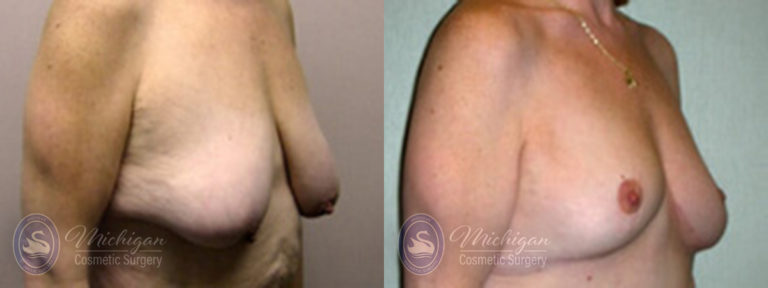 Breast Lift Before and After Photo by Dr. Awada in Southfield Michigan