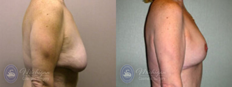 Breast Lift Before and After Photo by Dr. Awada in Southfield Michigan