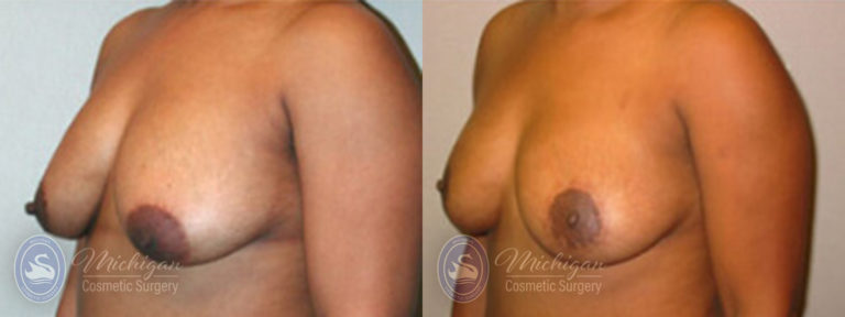 Breast Lift Before and After Photo by Dr. Awada in Southfield Michigan