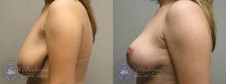 Breast Lift Before and After Photo by Dr. Awada in Southfield Michigan