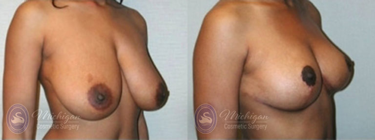 Breast Lift Before and After Photo by Dr. Awada in Southfield Michigan