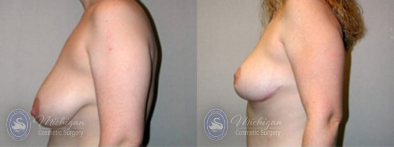 Breast Lift Before and After Photo by Dr. Awada in Southfield Michigan