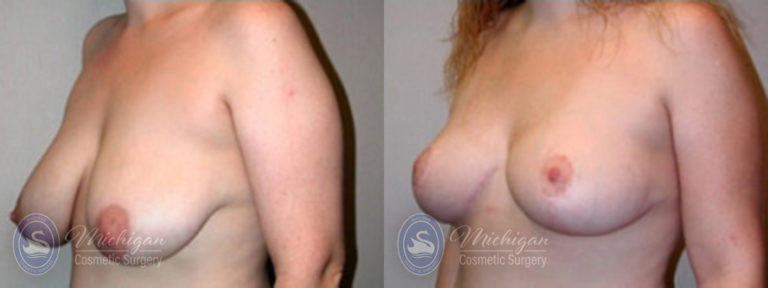 Breast Lift Before and After Photo by Dr. Awada in Southfield Michigan