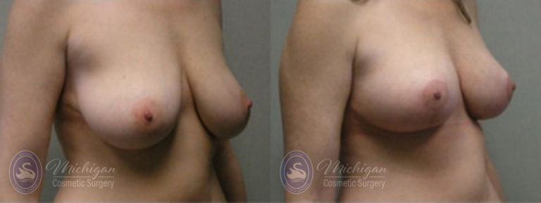 Breast Lift Before and After Photo by Dr. Awada in Southfield Michigan