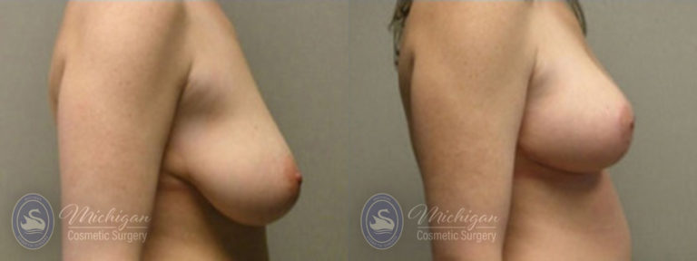 Breast Lift Before and After Photo by Dr. Awada in Southfield Michigan