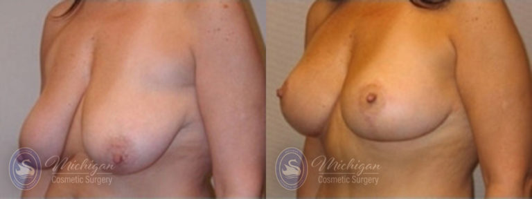 Breast Lift Before and After Photo by Dr. Awada in Southfield Michigan