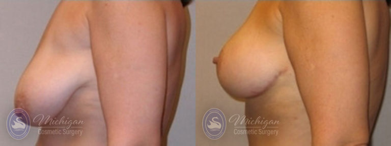 Breast Lift Before and After Photo by Dr. Awada in Southfield Michigan