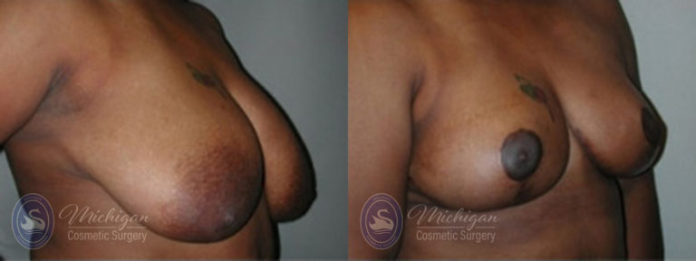 Breast Lift Before and After Photo by Dr. Awada in Southfield Michigan