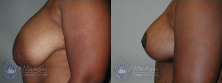Breast Lift Before and After Photo by Dr. Awada in Southfield Michigan