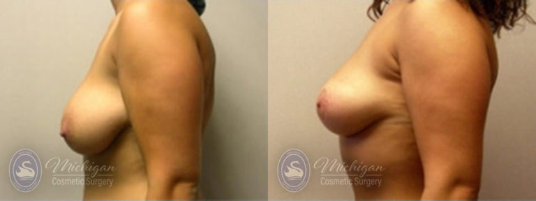 Breast Lift Before and After Photo by Dr. Awada in Southfield Michigan